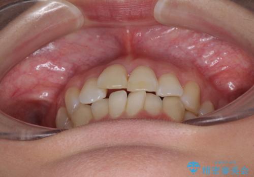 急速拡大装置で奥歯の咬み合わせを改善 インビザラインによる矯正治療の治療前