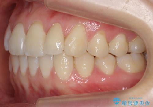 前歯が気になる 大人のマウスピース矯正 矮小歯を整えるの治療後