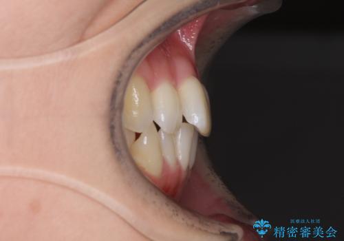 急速拡大装置で奥歯の咬み合わせを改善 インビザラインによる矯正治療の治療前