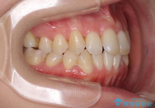 急速拡大装置で奥歯の咬み合わせを改善 インビザラインによる矯正治療の治療前