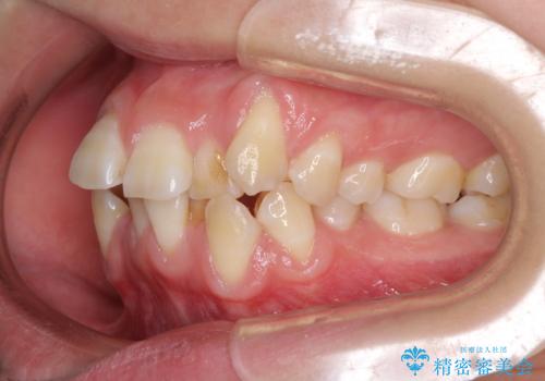 前歯が磨きにくい　目立たないワイヤー装置による矯正治療の治療前