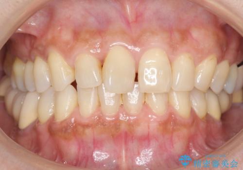 歯が痛い 深いう蝕により神経が死んでいる 50代女性の治療後