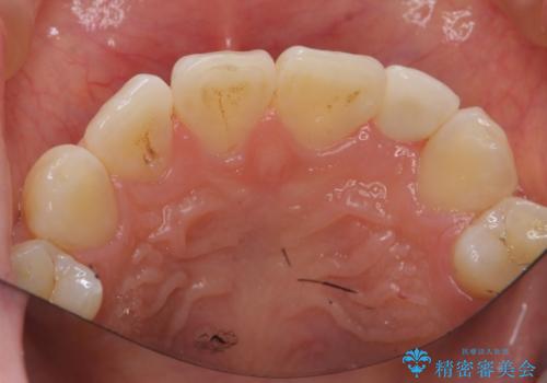 小さい前歯を整える　セラミック矯正の治療後