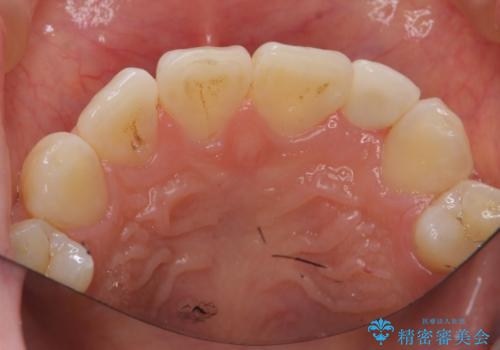 小さい前歯を整える セラミック矯正の治療後
