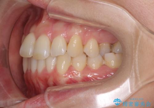 急速拡大装置で奥歯の咬み合わせを改善 インビザラインによる矯正治療の治療前