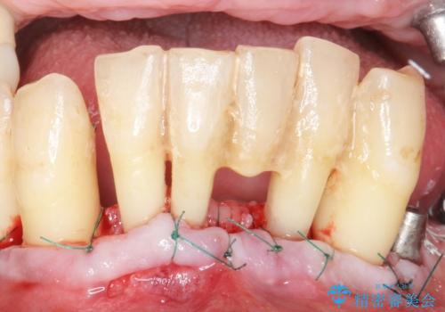 他院で抜歯と言われた歯 歯も神経も残したい 50代男性の治療中