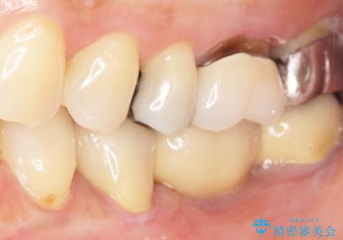 歯が痛い 深いう蝕により神経が死んでいる 50代女性の治療後