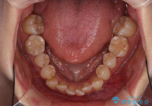 急速拡大装置で奥歯の咬み合わせを改善 インビザラインによる矯正治療の治療前