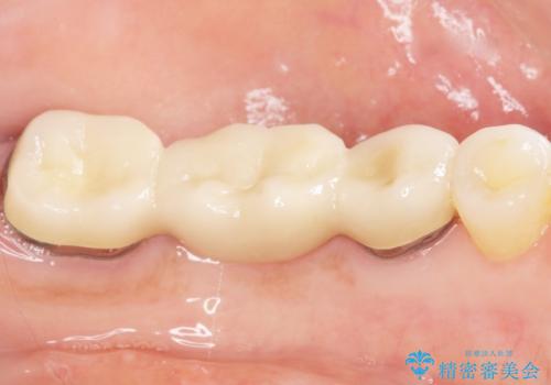 歯が痛い 深いう蝕により神経が死んでいる 50代女性の治療後