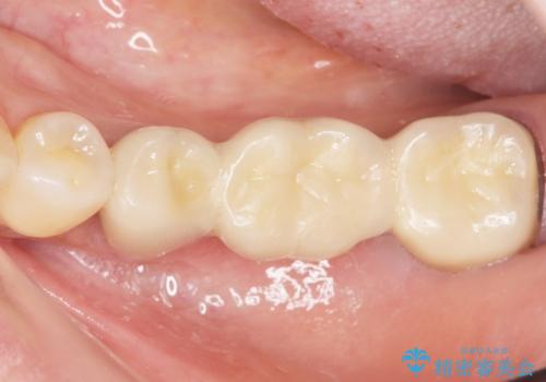 歯が痛い 深いう蝕により神経が死んでいる 50代女性の治療後