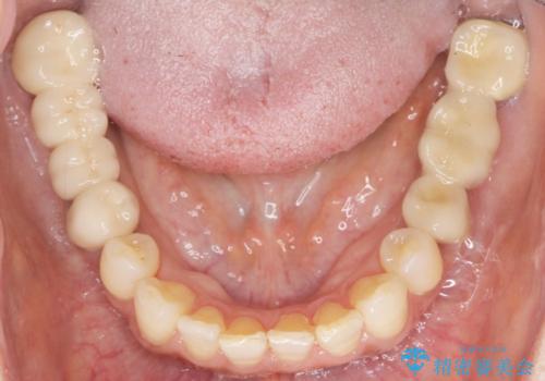 歯が痛い 深いう蝕により神経が死んでいる 50代女性の治療後