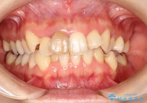上下のガタガタのマウスピースによる非抜歯矯正