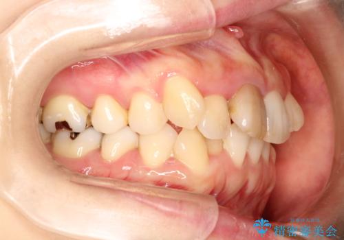上下のガタガタのマウスピースによる非抜歯矯正の治療前