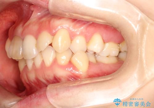上下のガタガタのマウスピースによる非抜歯矯正の治療前