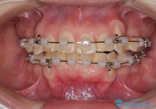 前歯が磨きにくい　目立たないワイヤー装置による矯正治療の治療中