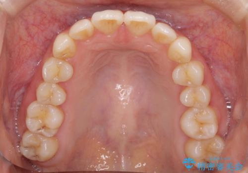 インビザラインを用いた非抜歯矯正の治療後