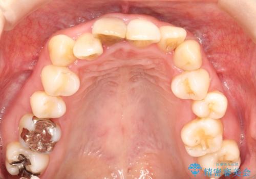 上下のガタガタのマウスピースによる非抜歯矯正の治療前