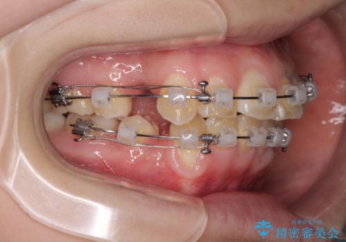 前歯が磨きにくい　目立たないワイヤー装置による矯正治療の治療中