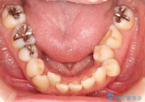 上下のガタガタのマウスピースによる非抜歯矯正の治療前