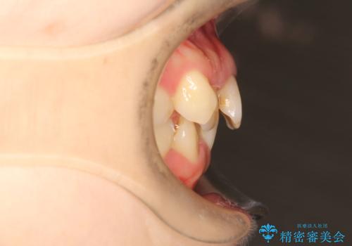 上下のガタガタのマウスピースによる非抜歯矯正の治療前
