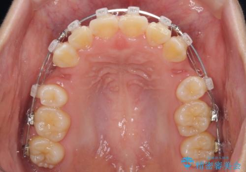 前歯が磨きにくい　目立たないワイヤー装置による矯正治療の治療中