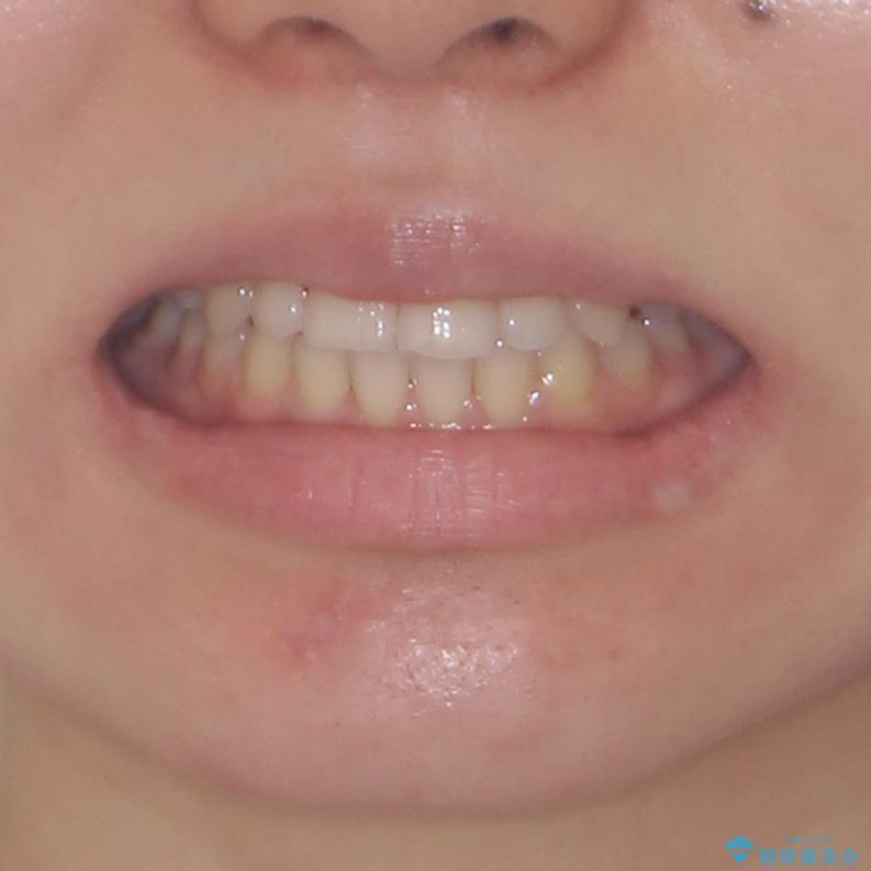 目立ちにくい抜歯矯正 ハーフリンガルの治療後(顔貌)