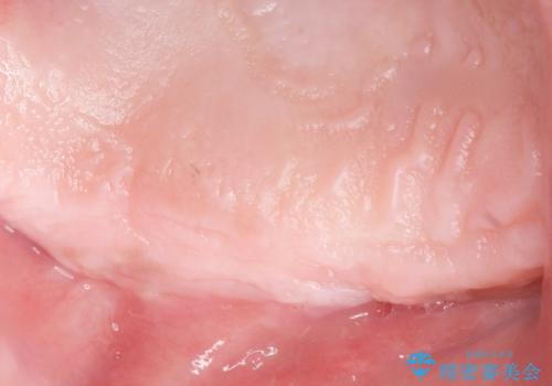 歯肉移植(FGG)による角化歯肉の獲得で長持ちするインプラントへ 50代男性の治療前