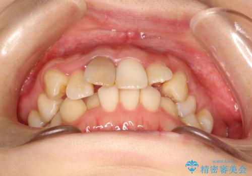 上下のガタガタのマウスピースによる非抜歯矯正の治療前