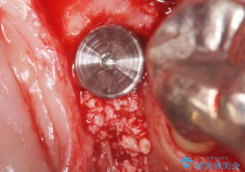 骨が少なくインプラントできないと言われた 下の奥歯のインプラント 60代男性の治療前