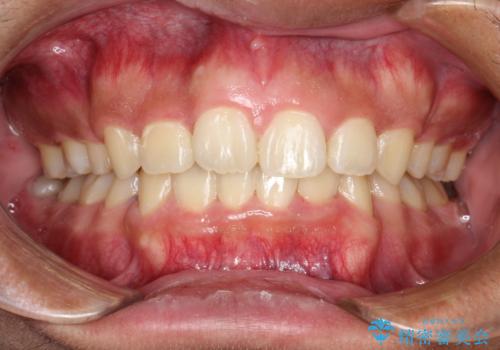 重度のガタガタ ワイヤーによる抜歯矯正の症例 治療後