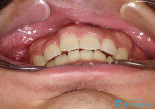 重度のガタガタ ワイヤーによる抜歯矯正の治療後