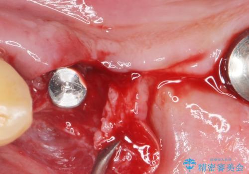 歯がぐらぐらで咬めない 奥歯のインプラント 50代男性の治療中