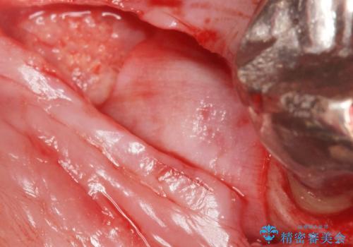 骨が少なくインプラントできないと言われた 下の奥歯のインプラント 60代男性の治療中