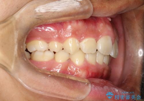 重度のガタガタ ワイヤーによる抜歯矯正の治療後