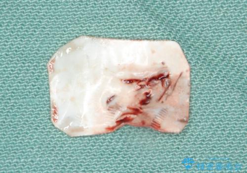 骨が少なくインプラントできないと言われた 下の奥歯のインプラント 60代男性の治療後