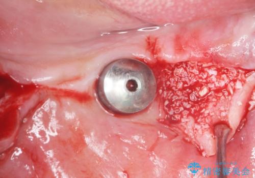 歯がぐらぐらで咬めない 奥歯のインプラント 50代男性の治療中