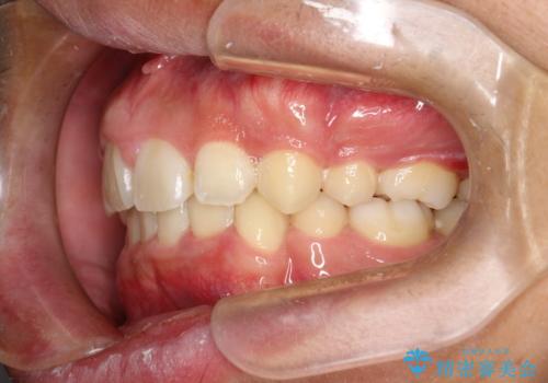 重度のガタガタ ワイヤーによる抜歯矯正の治療後