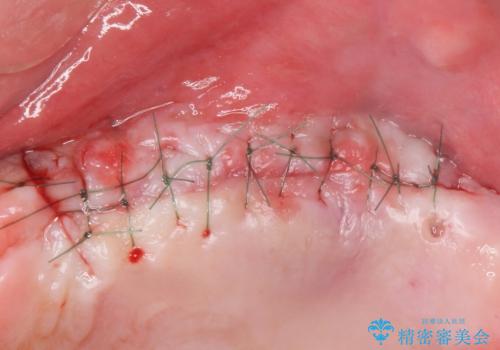 歯肉移植(FGG)による角化歯肉の獲得で長持ちするインプラントへ 50代男性の治療中