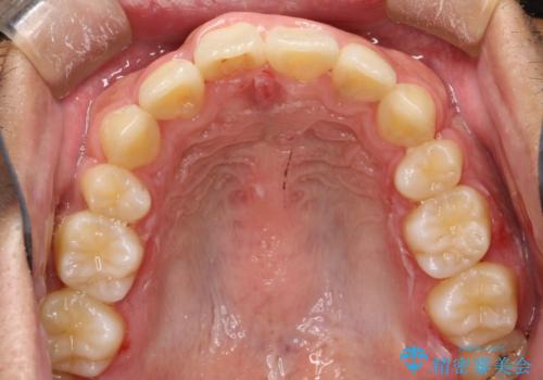 重度のガタガタ ワイヤーによる抜歯矯正の治療後