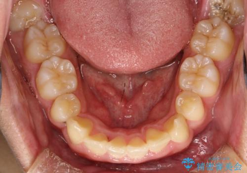 重度のガタガタ ワイヤーによる抜歯矯正の治療後