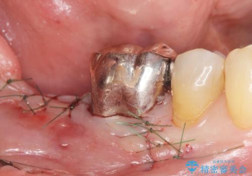 骨が少なくインプラントできないと言われた　下の奥歯のインプラント　60代男性の治療中