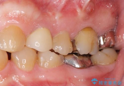 歯ぐきから出る膿　何度治療しても治らない　精密根管治療　50代男性の治療前