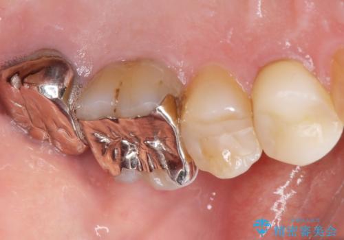 歯ぐきから出る膿　何度治療しても治らない　精密根管治療　50代男性の治療前