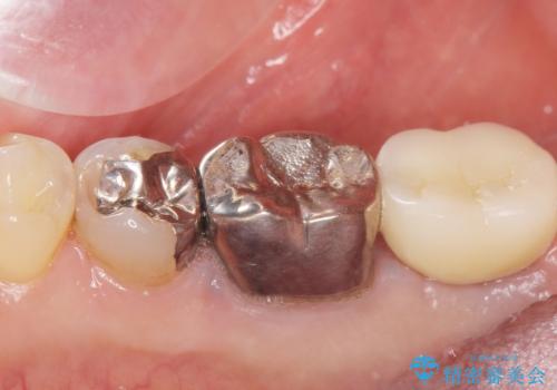 骨が少なくインプラントできないと言われた 下の奥歯のインプラント 60代男性の治療後