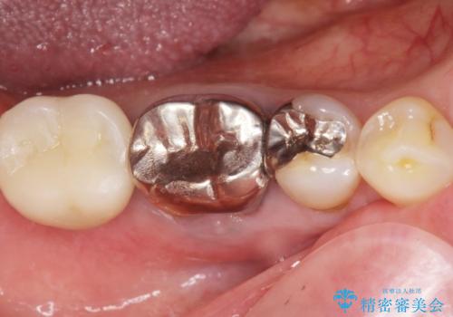 骨が少なくインプラントできないと言われた　下の奥歯のインプラント　60代男性の治療後