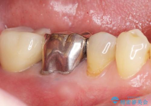 骨が少なくインプラントできないと言われた 下の奥歯のインプラント 60代男性の治療後