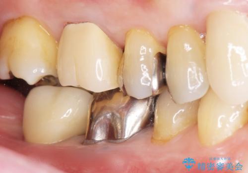 骨が少なくインプラントできないと言われた 下の奥歯のインプラント 60代男性の症例 治療後