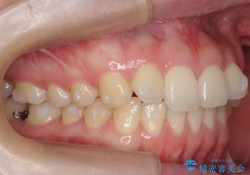 下の前歯が1本短い　インビザラインと部分矯正の組み合わせの治療中