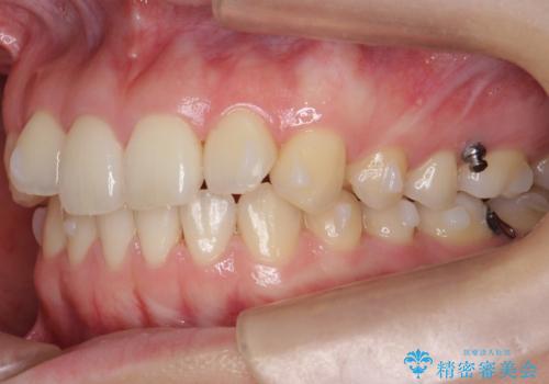 下の前歯が1本短い インビザラインと部分矯正の組み合わせの治療中