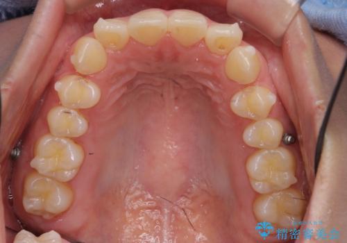 下の前歯が1本短い インビザラインと部分矯正の組み合わせの治療中